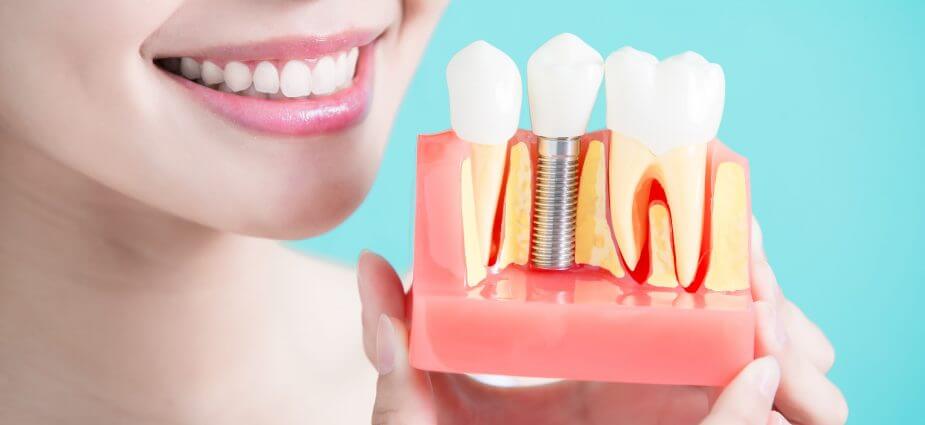 dental-implants