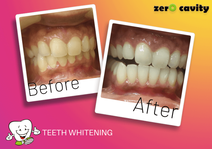 Teeth Whitening